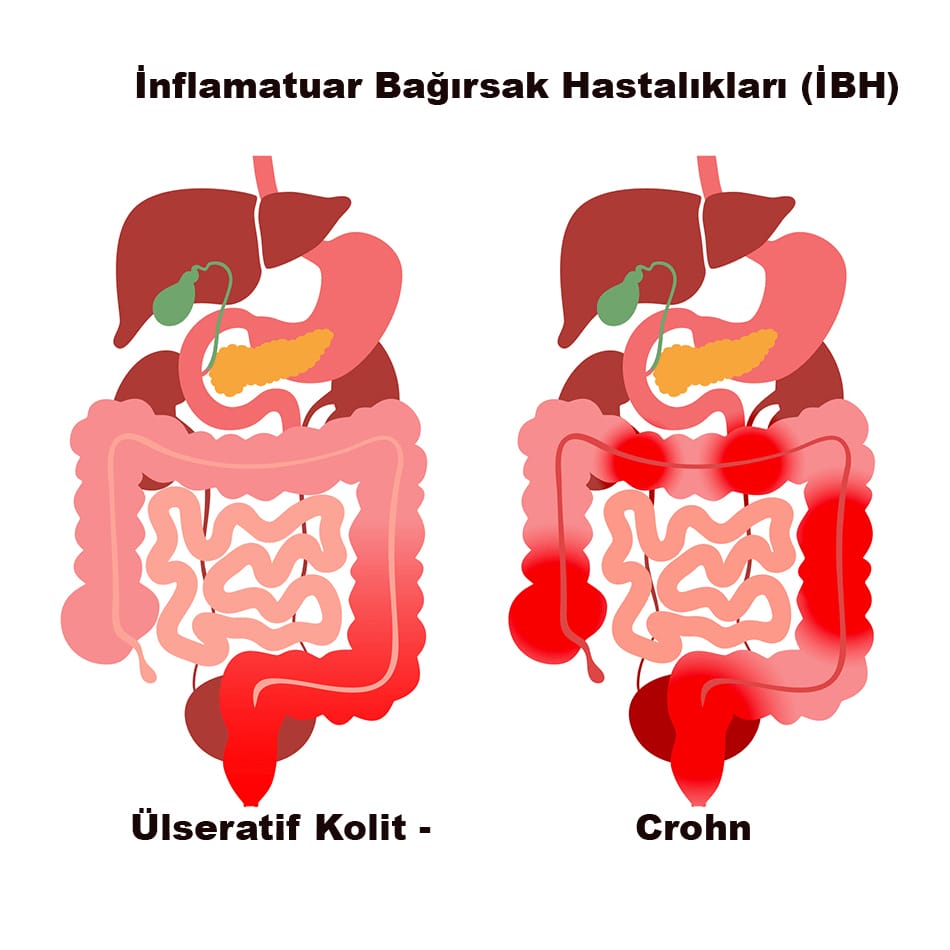 inflamatoria