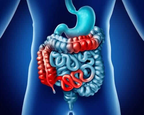 inflamatoria