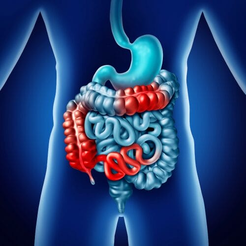 inflamatoria